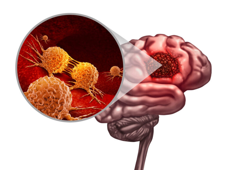 Glioblastoma Therapy May Be Improved by Targeting Specific Enzyme