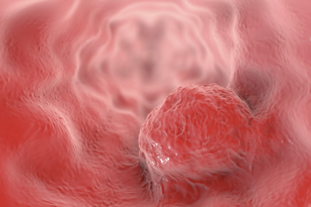 Esophageal cancer, illustration