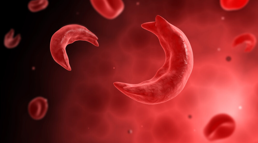 Microscopic view of sicke cells causing anemia disease.