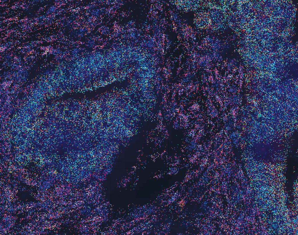 Colon Cancer