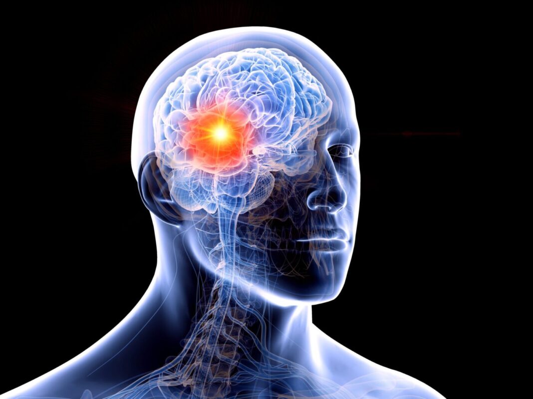 Human brain tumour, illustration