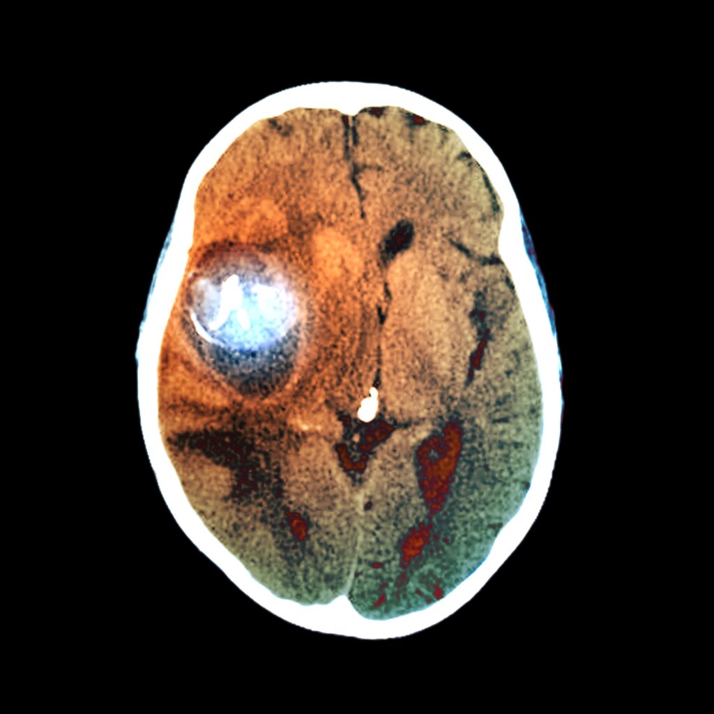 Aneurysm, CT scan