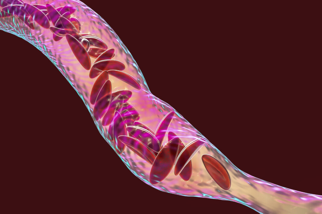 Blood vessel blocked in sickle cell anaemia, illustration