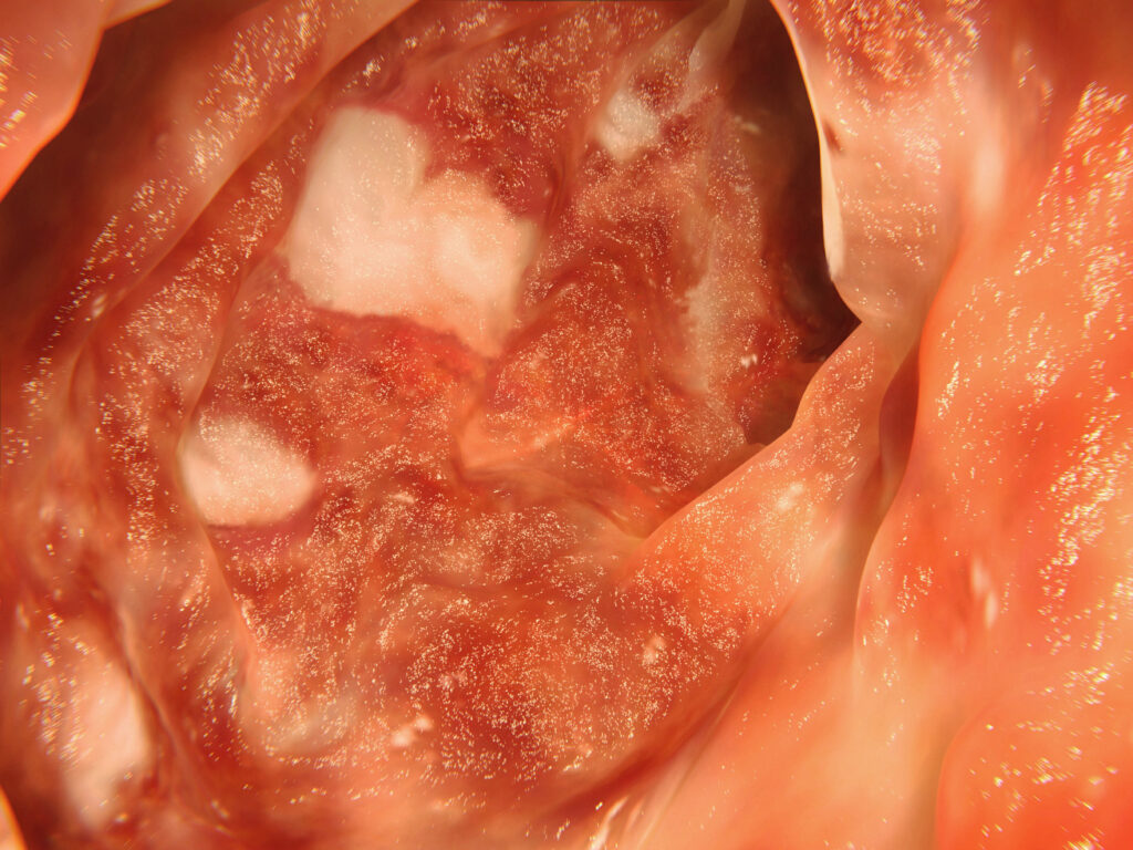 Ulcerative colitis, artwork