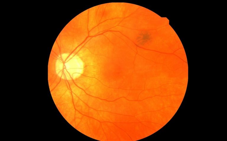 Eye Scans Open a Window into Heart Health