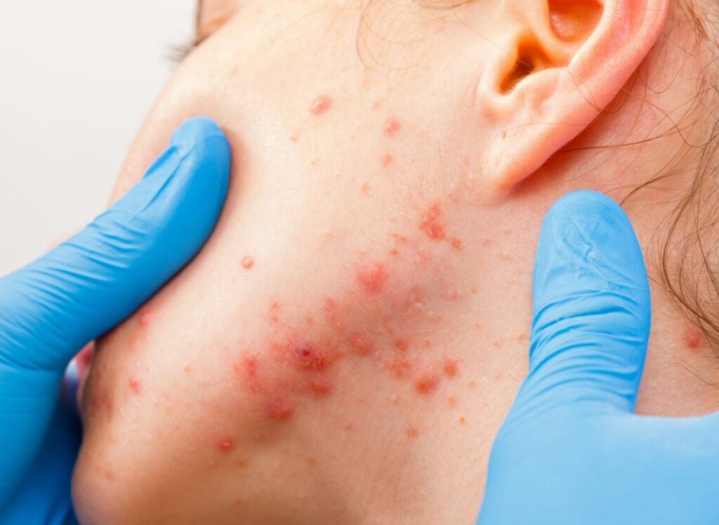 Acne skin