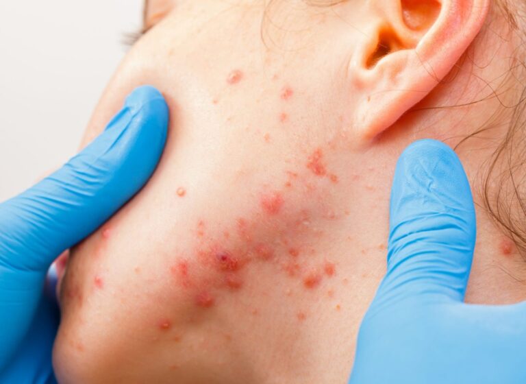 Acne-Risk Gene Discovery Opens Door to Potential New Therapies