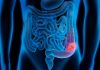 Aspirin Appears to Protect against Colon Cancer by Boosting Immunosurveillance