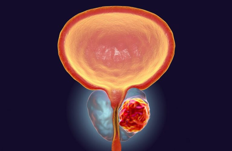 Combination Therapy Found to Prolong Survival of Hormone-Sensitive Prostate Cancer