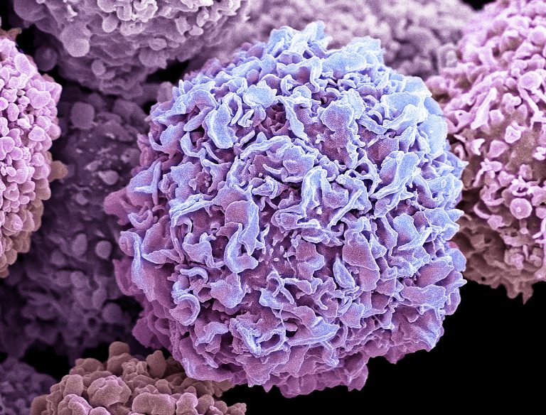 AACR: Breast Cancers Have DNA Repair Crutch Kicked Away by Saruparib