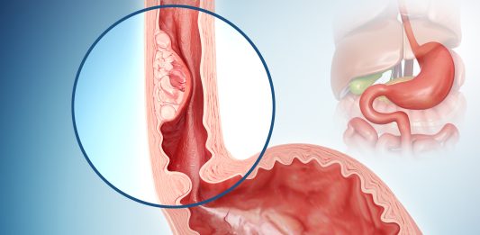 Oesophageal cancer, illustration