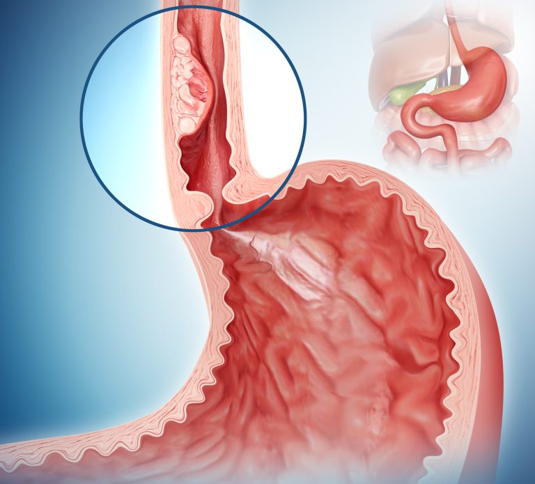 Genetic Changes Identified in Patients Who Later Develop Esophageal Cancer