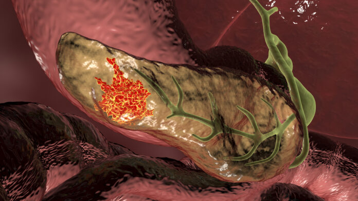 Pancreatic Cancer