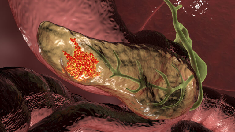 Resistant Pancreatic Cancer Uncovered in Unprecedented Detail
