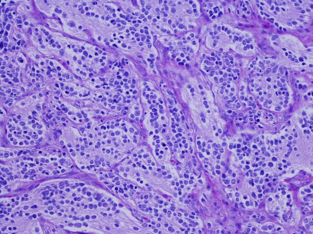 Neuroblastoma