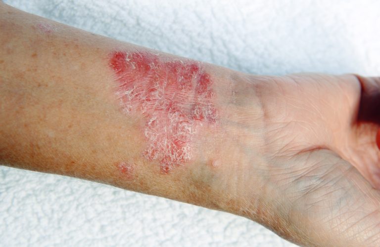 Culprit behind Psoriasis Revealed