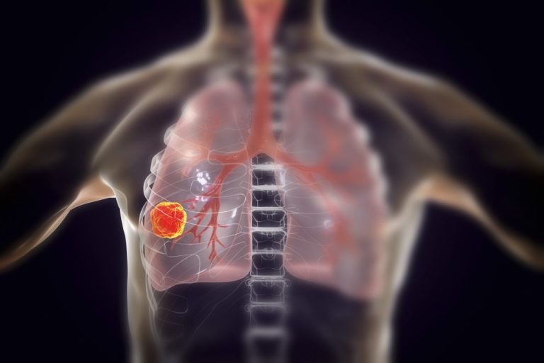 Lung Tumor Growth Potentially Reduced by Novel Approach