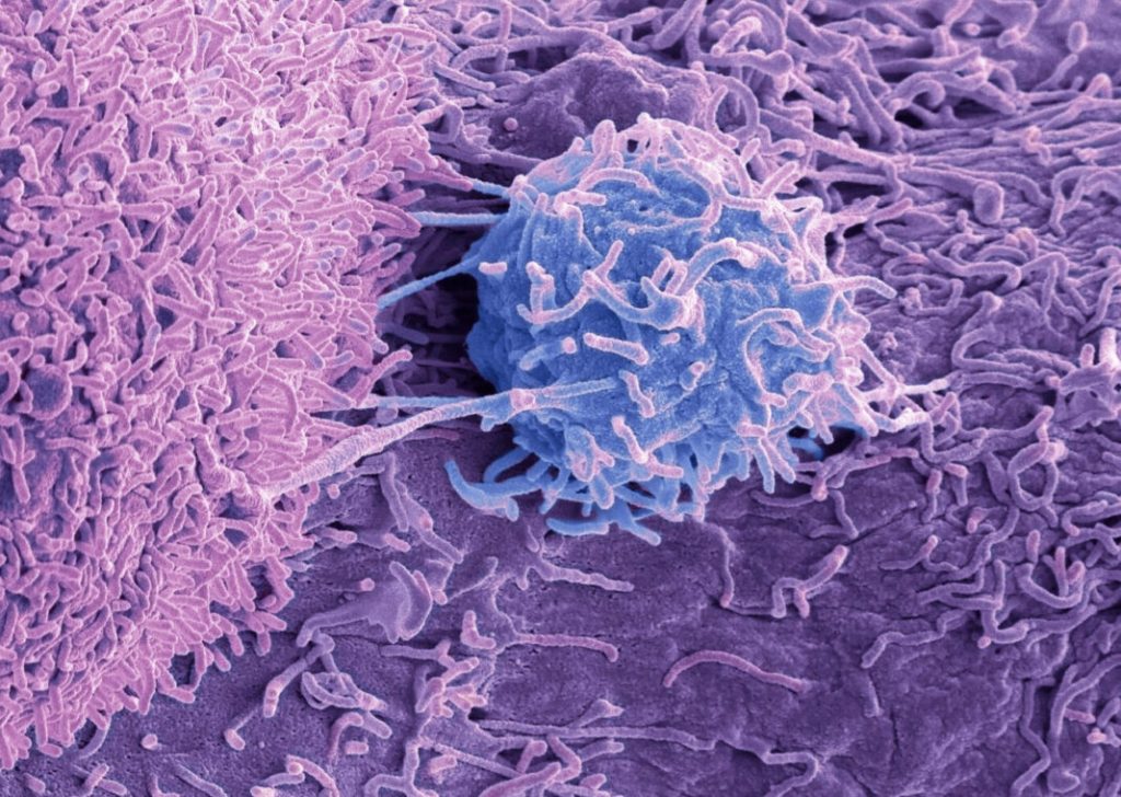 Prostate cancer cells, SEM