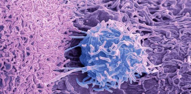 Prostate cancer cells, SEM