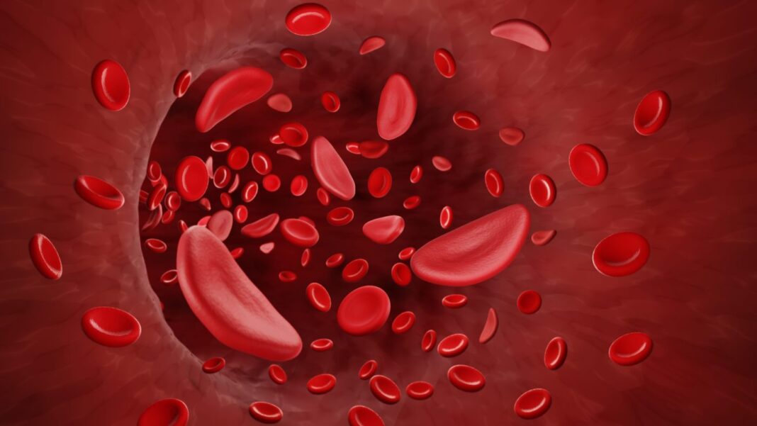 Sickle cells in bloodstream