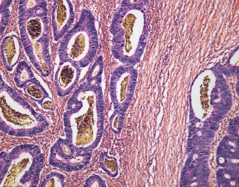New Gene Essential to Colon Cancer Growth Identified