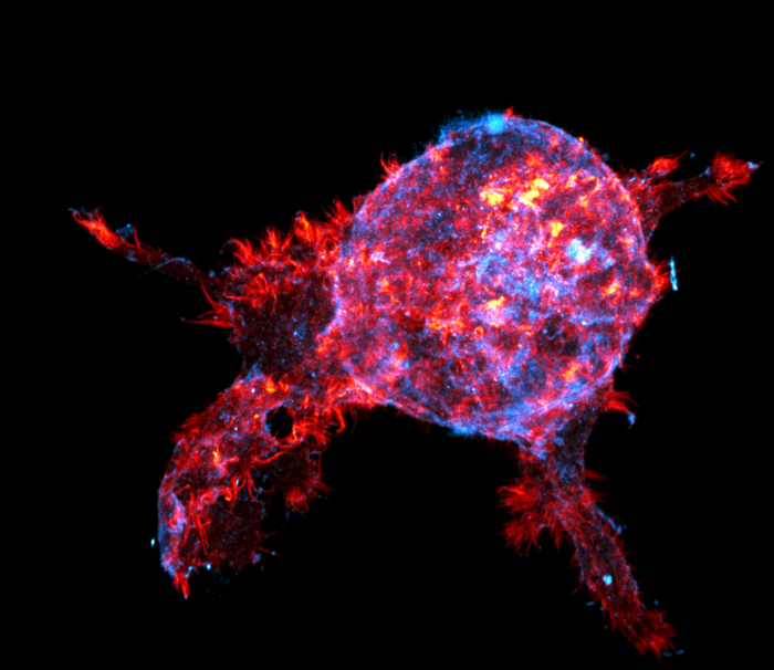 Barrier That Protects Breast Tumors Identified
