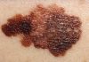 Melanoma Metastasis in the Brain Linked to New Cell Signaling Pathway