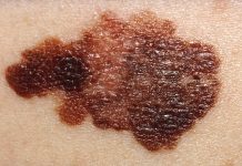 Melanoma Survival Rate Boosted by Memory Cells