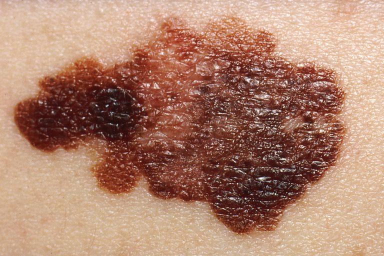 Melanoma Survival Rate Boosted by Memory Cells