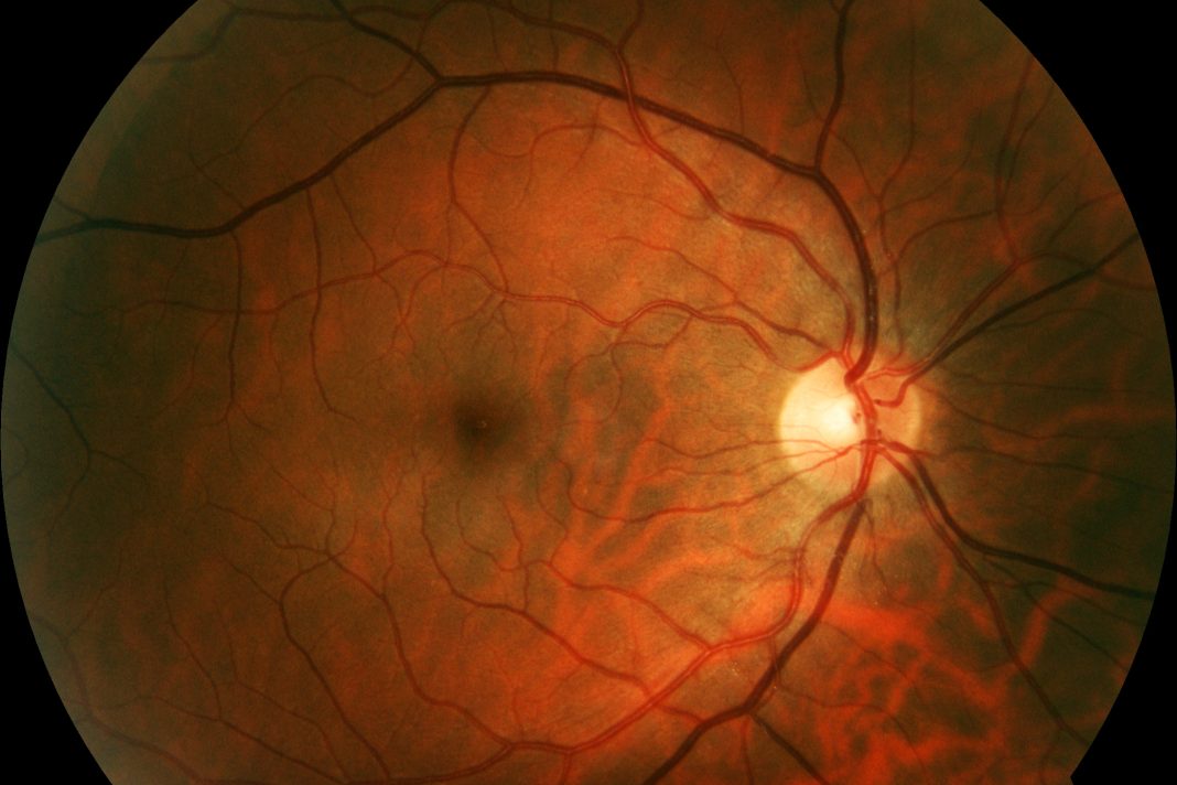 Retinal photograph of human eye
