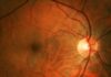 Brain Tumors, Infections May Have an Achilles’ Heel … in the Eye