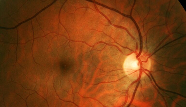 Opus Genetics Acquires Two Gene Therapy Candidates for Inherited Retinal Diseases