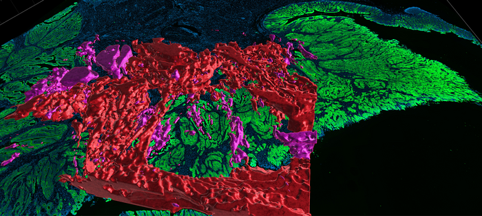 3D Spatial Colorectal Cancer Maps Combine Molecular and Histological Features