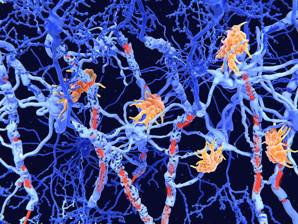 Nerve damage in multiple sclerosis