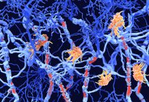 Blood Biomarker Reveals Signs of Multiple Sclerosis Years Before