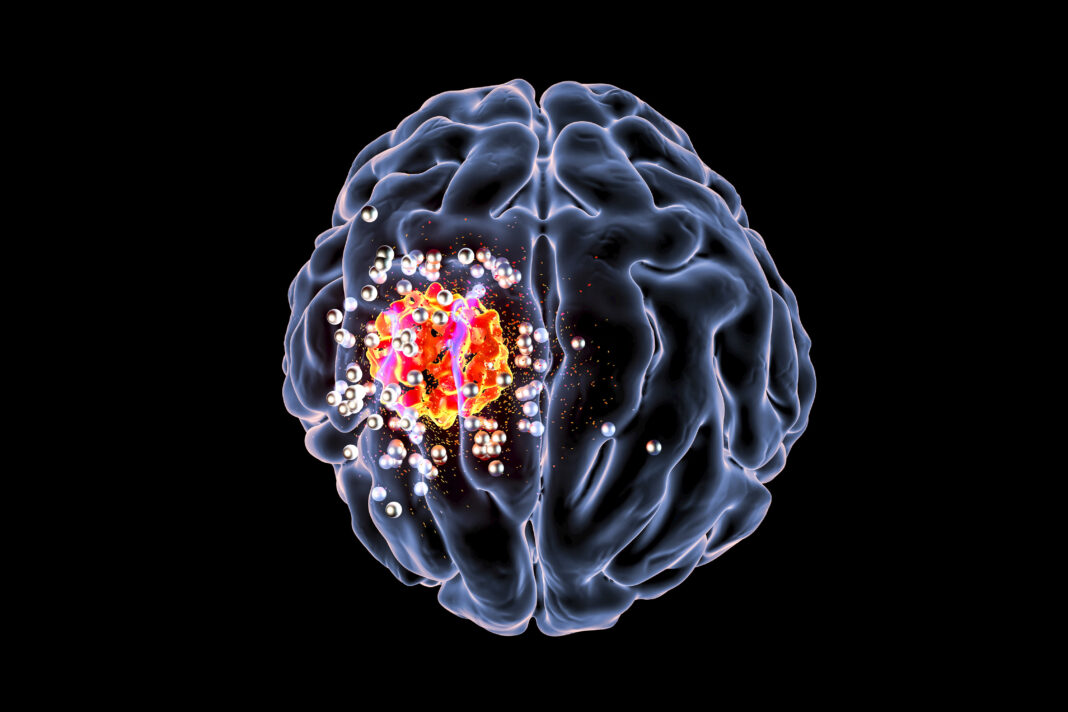 nanoparticles targeting brain cancer