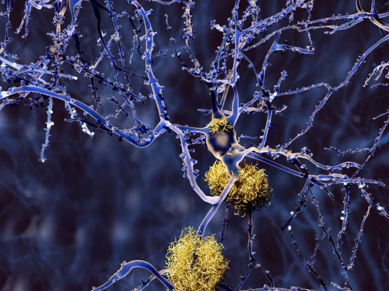 Neurons Identified That May Contribute to Early Alzheimer’s Disease Symptoms