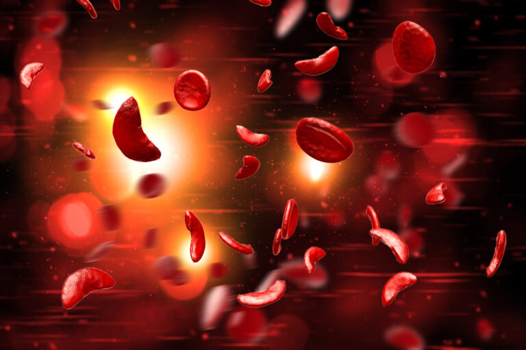 Prime-Edited Patient Blood Stem Cells Fully Engraft and Rescue Sickle Cell Mice