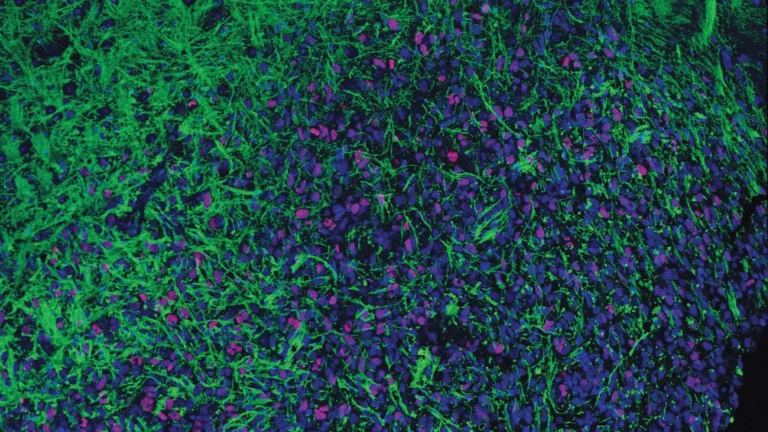 Antisense Oligonucleotides Help Treat Deadly Brain Cancer in Mice
