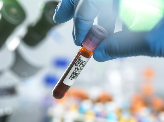 Blood Test Plus Personalized Model May Predict Lung Cancer Death Risk