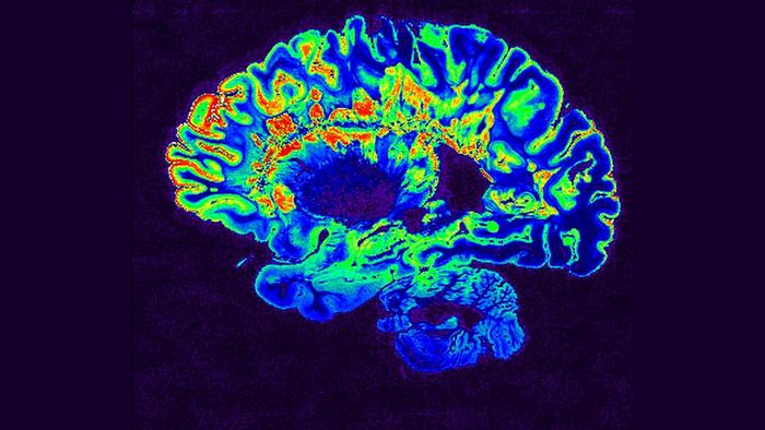 MRI image in false colors of a brain hemisphere from a patient with multiple sclerosis. Areas affected by the autoimmune disease are shown in red.