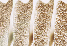 Gut Microbiome and Bone Density Connection Found