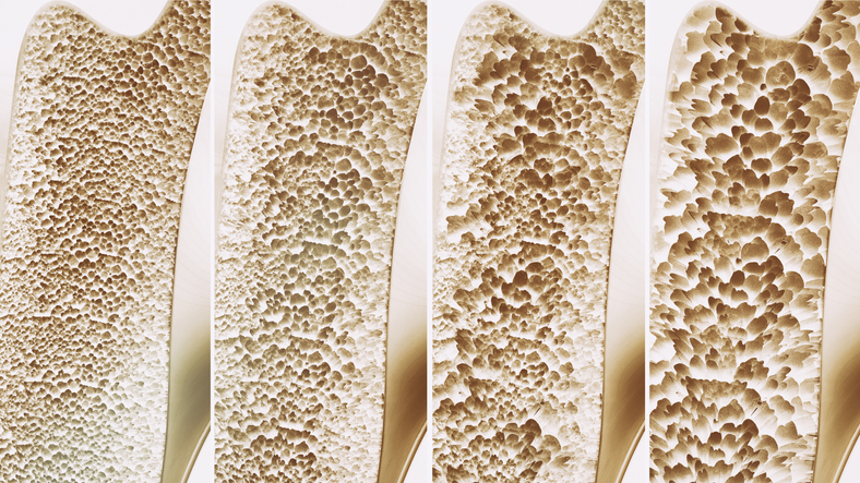 Se encuentra conexión entre el microbioma intestinal y la densidad ósea