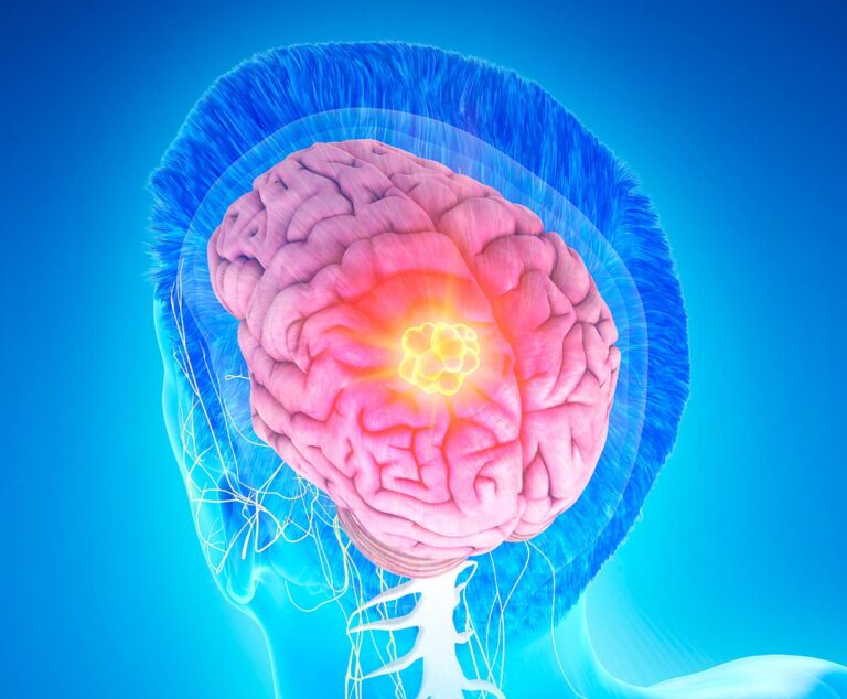 Human Brain Tumor Implant Could Guide Personalized Therapies
