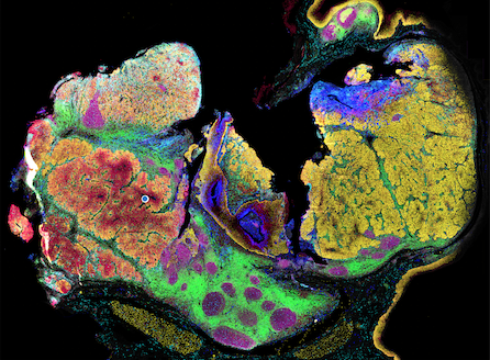 Spatial Proteomics Maps Head and Neck Tumors, Targets Biomarkers