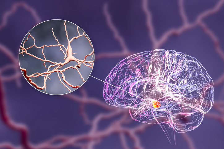 Gene Variant Linked to New Forms of Early-Onset Dystonia, Parkinsonism