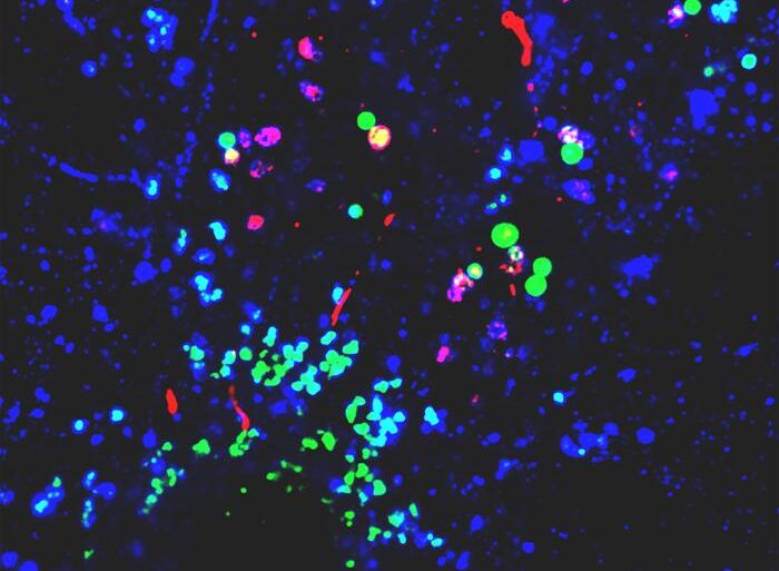 Plastic nanoparticles (green), visible under a microscope, co-mingling with protein aggregates(red) in neuronal lysosomes (blue). Typically, concentrations of the protein aggregates are so small, they would not be viable at this level.