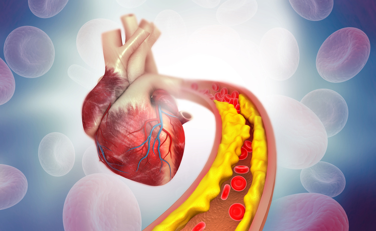 Atherosclerosis Atlas Sheds Light on Heart Attacks and Strokes