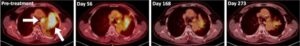 Chest scans showing lung tumors in a patient with metastatic non-small cell lung cancer prior to and after receiving dupilumab with conventional immunotherapy.