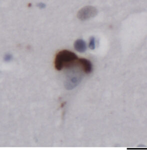 Inclusions of aggregated TAF15 (brown) in the brain of an individual with frontotemporal dementia. Scale bar, 50 μm.